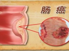 ☀学术 | 结直肠癌脑转移的临床特征及诊断治疗