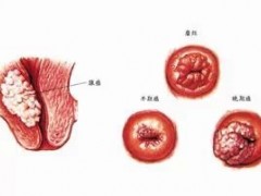 贝伐单抗治疗晚期宫颈癌获FDA优先审批