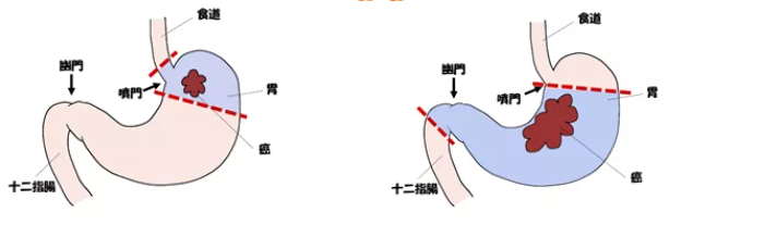 日本癌研有明医院肺癌手术图