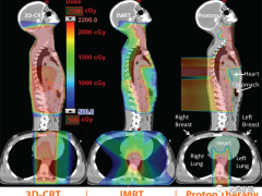 恶性淋巴瘤放疗,质子治疗淋巴瘤二次患癌风险减少50%