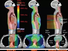 淋巴瘤放射治疗,质子治疗恶性淋巴瘤二次患癌风险减少50%