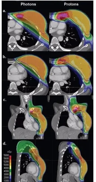 肺癌质子治疗和光子治疗对比
