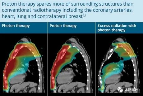 乳腺癌质子治疗和传统放疗放射区域对比