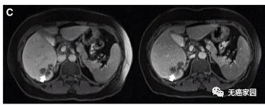 CAR-T治疗后P10的一个肝脏病变发生萎缩