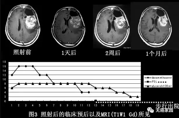 硼中子治疗脑胶质瘤前后对比