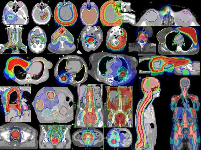 TOMO放疗可以治疗的肿瘤