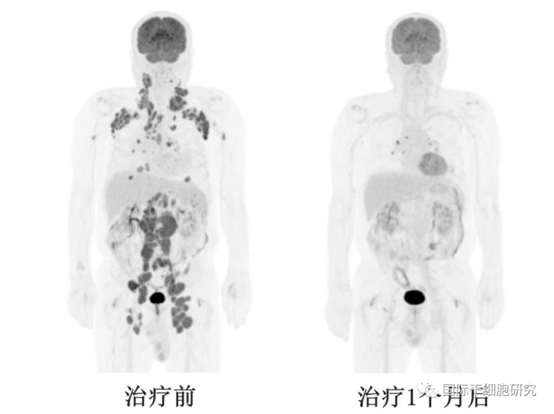 AT101治疗效果