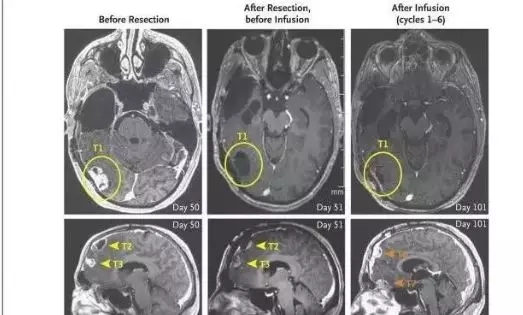 CAR-T疗法治疗脑瘤效果