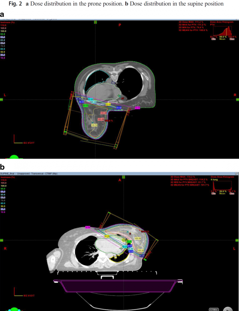 乳腺癌病人在俯卧位和俯卧位的的射野安排对比