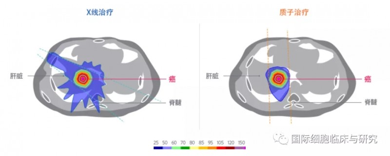 质子放疗和传统放疗放射剂量对比