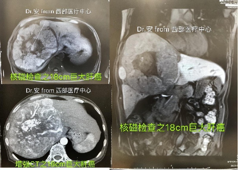 18厘米的巨大肝癌