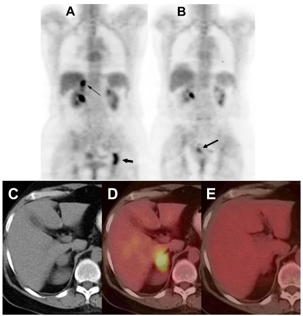 电场治疗乳腺癌的效果