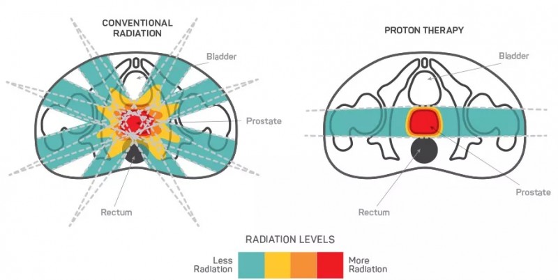 前列腺癌质子治疗