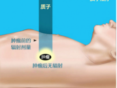 鼻咽癌放疗,拯救球王李宗伟、韩星金宇彬的质子治疗到底是何方神圣