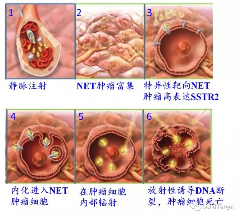 神经内分泌瘤