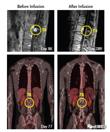 脊索瘤CAR-T治疗前后对比