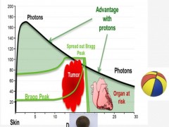 质子治疗的优势