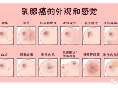 乳腺癌的早期症状和前兆有哪些,预防乳腺癌的方法有哪些