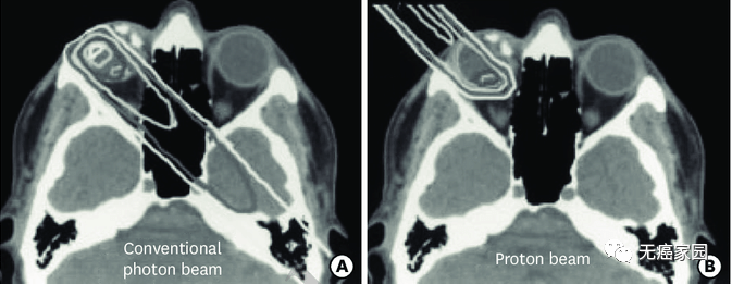 质子束和常规光子束治疗对比