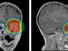 儿童眼癌放疗,眼癌质子治疗早期治疗效果极佳,眼癌CAR-T细胞疗法与水凝胶联合治疗效果显著