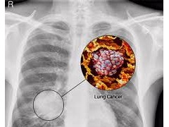 FDA 批准 durvalumab 用于治疗膀尿路上皮癌