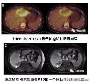 CAR-T细胞治疗CEA阳性的结直肠癌的有效性和安全性