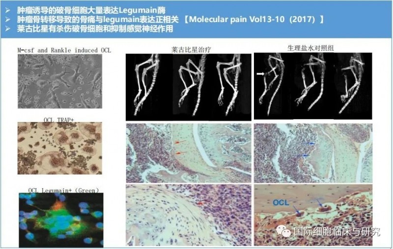 莱古比星骨转移的治疗效果