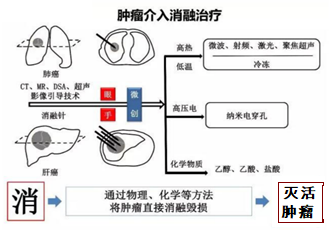 肿瘤介入消融治疗