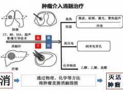 癌症肿瘤介入消融技术,肿瘤消融治疗让肿瘤治疗更安全高效