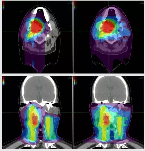 头颈癌质子治疗和传统放疗对比