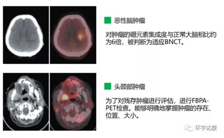 硼中子俘获治疗效果