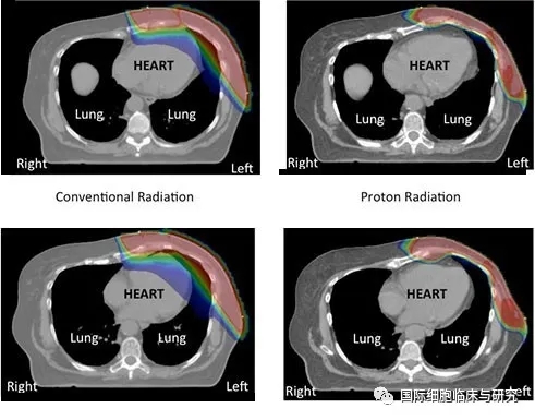 传统光子疗法与质子疗法的放射范围对比