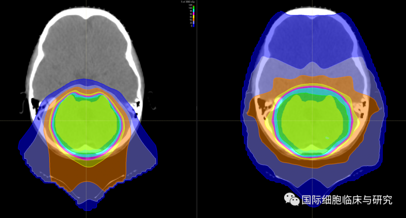质子治疗和传统放疗照射范围对比