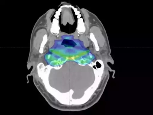 鼻咽癌治疗前CT图像