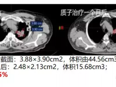 直播预告|知名肿瘤专家全面揭秘：肺癌质子治疗的优势与适应症！