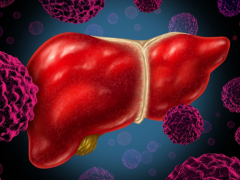 肝癌新疗法,肝癌治疗新方法,肝癌治疗新技术,首款肝癌免疫治疗一线方案国内即将上市