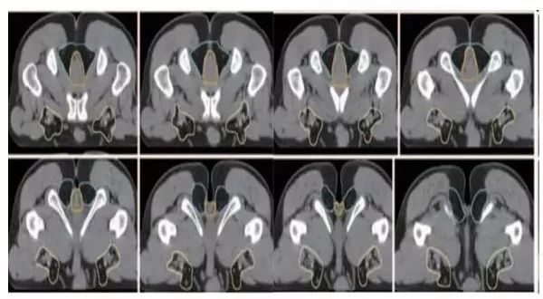 直肠癌放疗分区勾画