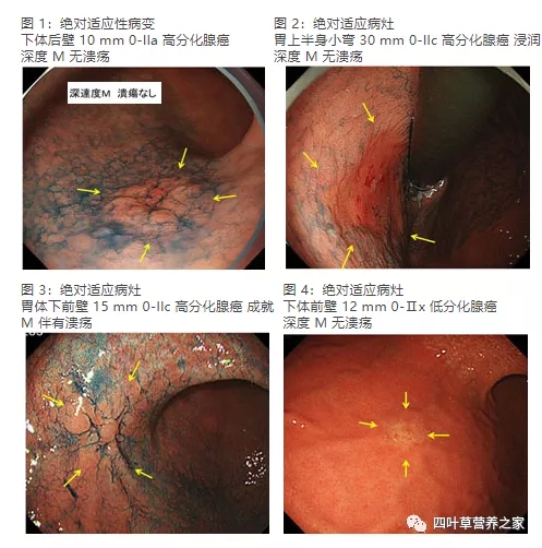 ESD治疗的胃癌适应症