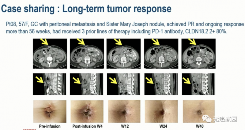 CT041治疗腹膜转移的效果