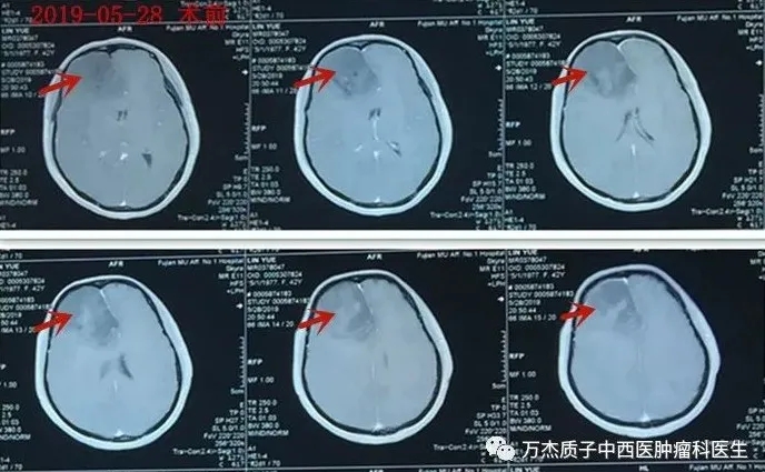 胶质母细胞瘤手术前MR肿瘤巨大