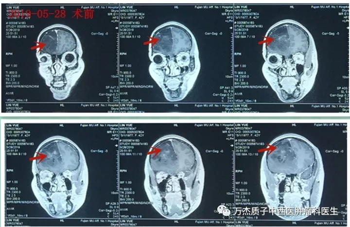 胶质母细胞瘤手术前MR肿瘤巨大