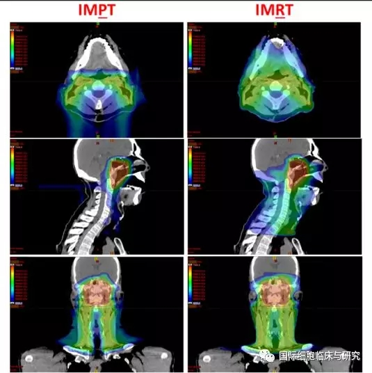 鼻咽癌质子治疗案例