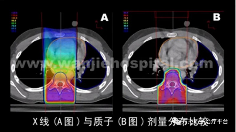 肝癌质子治疗和传统放疗辐射面积对比