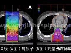 肝癌质子治疗,质子刀治疗原发性肝癌安全有效、优势明显、肿瘤周围正常肝脏组织免受照射