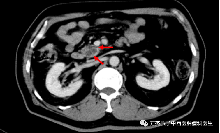 胰腺癌病灶影像图