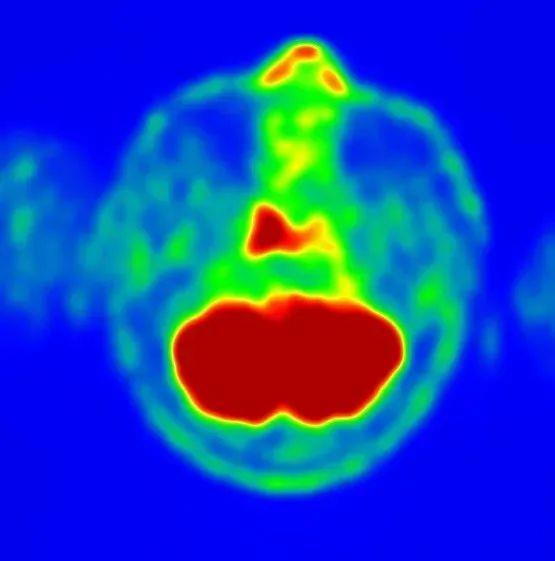 质子治疗钱的鼻咽癌PETCT